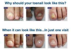 Medical nail restoration