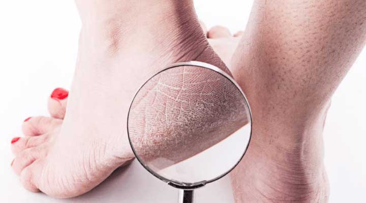 Podiatrists tips for dry skin