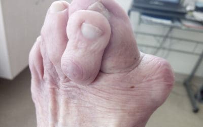 Podiatry can help with Arthritis