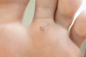 What is a Plantar Wart
