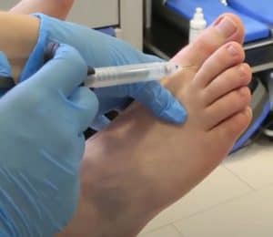 Podiatrist injecting a toe with local anaesthetic.