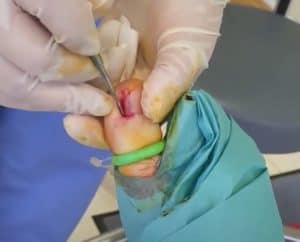 Podiatrist removing an ingrown toenail under local anaesthetic.